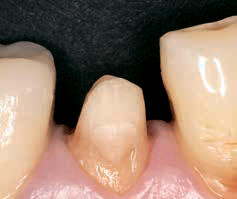 Препарирование под пластмассовую коронку